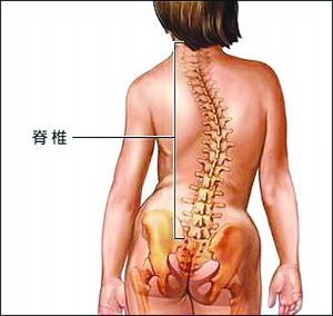 脊椎侧弯