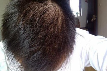 肾虚型脱发怎么改善?肾虚型脱发的原因