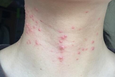 脖子上长痘痘什么原因？这五个因素造成得及时改善