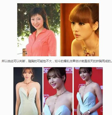 女星隆胸前后对比照片图