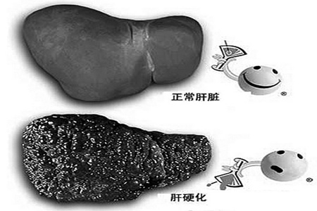 肝硬化喜欢这三类人,这两个部位会呈现肝硬化的早期症状