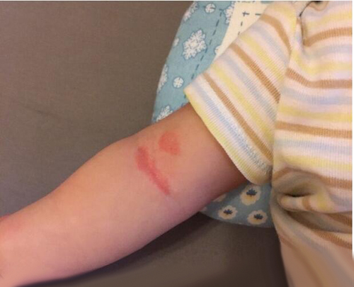 新生儿身上起疹子不会消退的