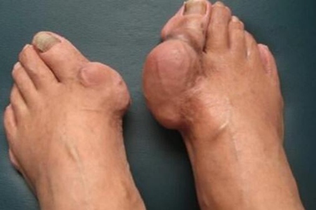 痛风不能吃哪些东西?这五种食物禁忌别贪吃害自己