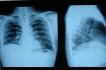 肝癌是怎么原因引起的?改掉四个不良习惯预防肝癌