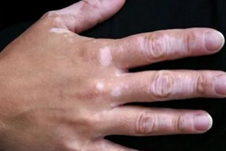 我的手上有白斑是什么?这四个原因引发及时治疗改善