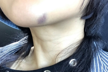 渣男张嫮目家暴曝光,掰断食指还强迫发生性关系