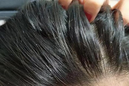 头发爱出油还脱发怎么办?这四个方法能拯救你的头发
