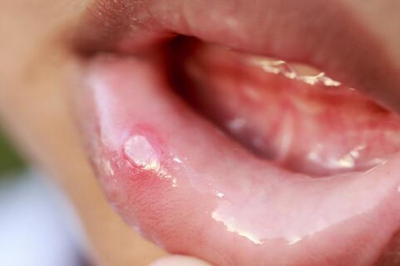 经常口腔溃疡是什么原因?这五个因素导致得及时改善治疗