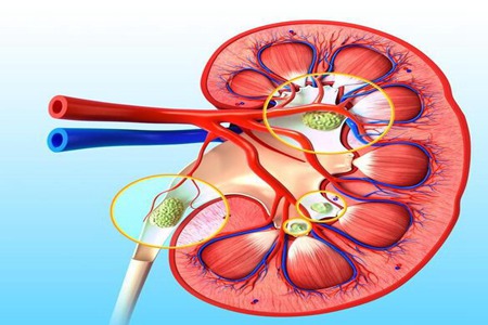 激光碎石有什么用？激光碎石后需要注意什么？