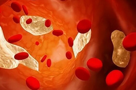 血栓是怎么形成和引起的？这四个因素有着极为密切的联系