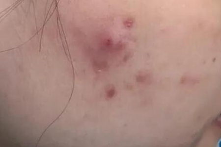 脸上长痘痘老是反反复复发怎么办？这四个因素及时改善恢复美貌