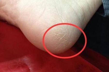 脚后跟干裂起硬皮怎么办,这三个脚后跟干裂治疗方法