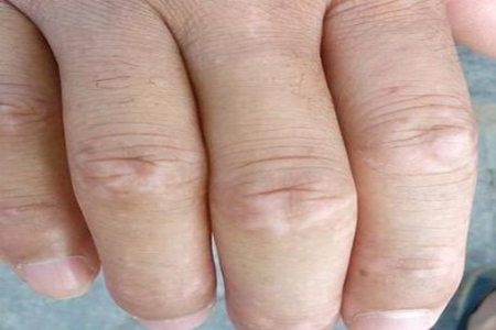 我的手上有白斑是什么?这四个原因引发及时治疗改善