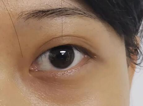 熬夜黑眼圈怎么去除？这五个方法拯救肌肤改善黑眼