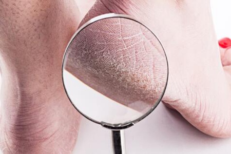 脚后跟干裂起硬皮裂口子怎么办?这五个方法能改善脚后跟开裂症状