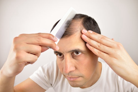 男人头发秃顶怎么治?生活中做好这四件事能缓解秃顶