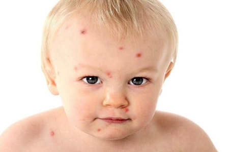 儿童皮肤过敏的治疗和预防，宝妈们注意皮肤过敏药