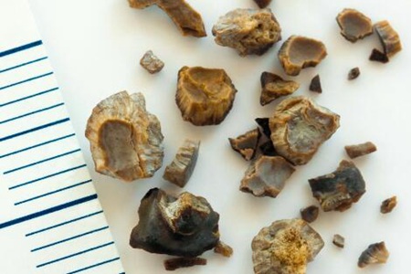 肾结石不能吃什么食物?这五种食物尽量少吃能预防结石