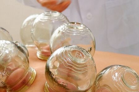 拔罐能去除体内湿气吗？这五种拔罐的好处和坏处