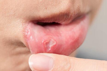 口腔溃疡是什么原因造成?这五个幕后黑手诱发溃疡症状