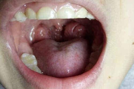 鹅口疮怎么治疗