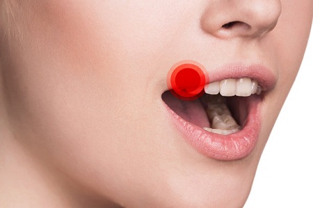 口腔溃疡影响过年?吃好饺子就要这样做