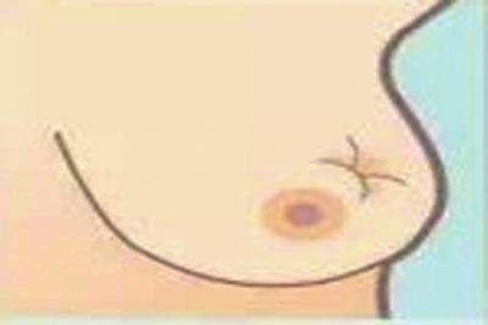 乳腺癌早期有什么症状?哪些人容易患上