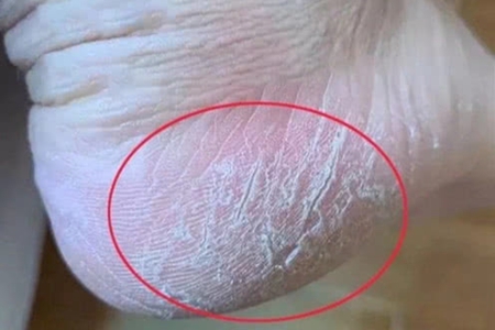 脚后跟干裂起硬皮怎么办,这三个脚后跟干裂治疗方法