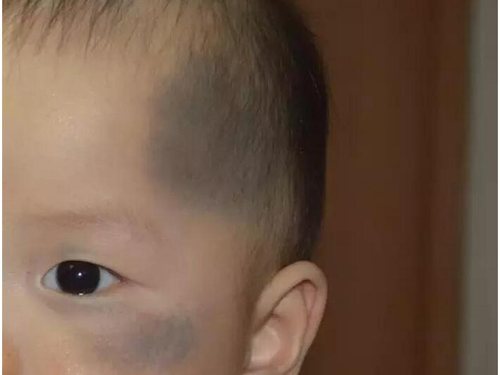 宝宝胎记是怎么形成的