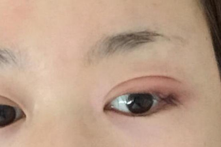为什么会长针眼?这四个诱发眼睛不断长针眼的原因