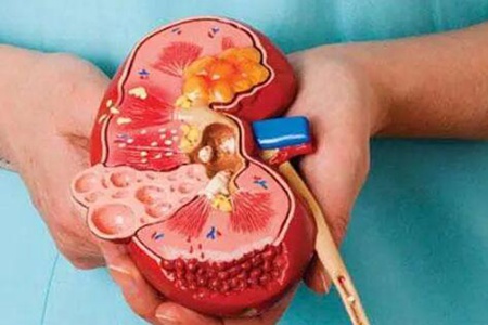 肾结石是什么原因引起的?这五个因素造成得趁早改正