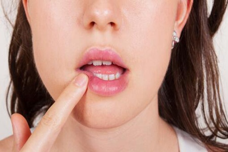 口腔溃疡的治疗方法,治疗溃疡只需要4点做好