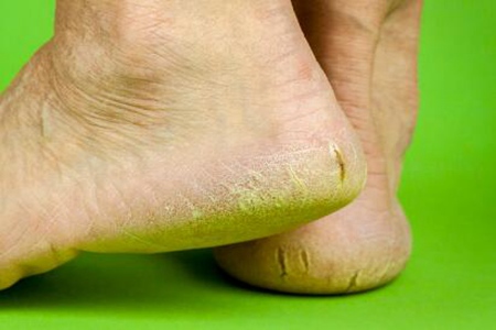 脚后跟干裂起硬皮裂口子怎么办?这五个方法能改善脚后跟开裂症状