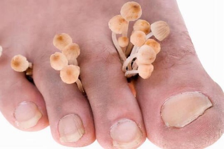 有脚气怎么办快速解决?这五个治疗方法解决脚困扰