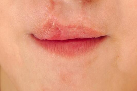 唇炎的症状有哪些?这五个因素及时改善治疗