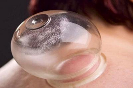 刮痧和拔罐的区别?女人湿气重刮痧好还是拔罐好