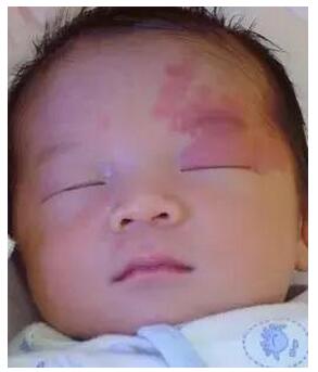 宝宝胎记是怎么形成的