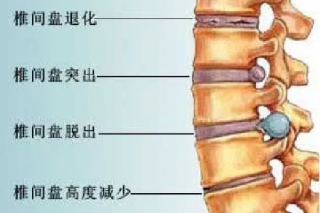 腰间盘突出怎么治疗最好的方法 专家这样说