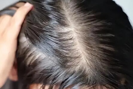 头发爱出油还脱发怎么办?这四个方法能拯救你的头发