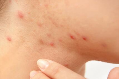 脸上长痘痘老是反反复复发怎么办？这四个因素及时改善恢复美貌