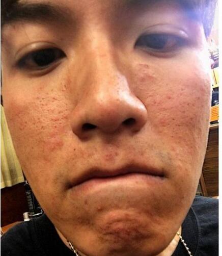 中国卸妆后最丑女明星烂脸爆痘照