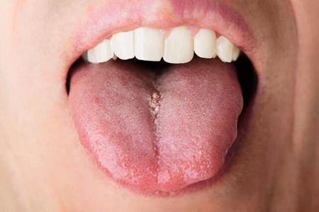 舌头边缘有齿痕是什么原因?这三个女性舌头两侧有齿痕原因