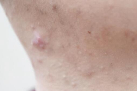 脖子上长痘痘什么原因？这五个因素造成得及时改善