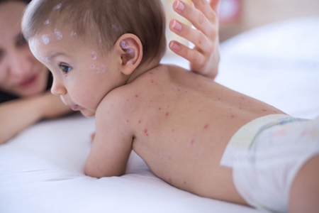 水痘的症状和治疗，这三个出水痘的症状宝妈要注意