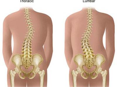 脊椎侧弯