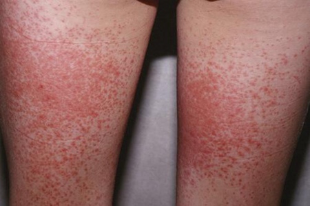 判断女性艾滋病最简单方法？这四个表现出现及时找医生看看