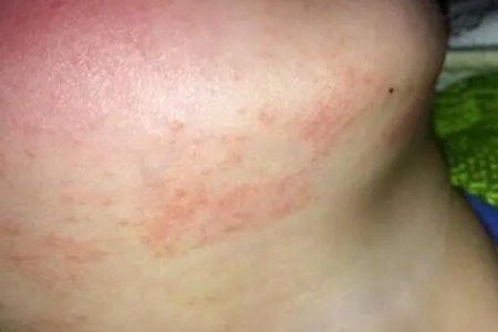 宝宝长湿疹怎么办?这四个方法护理是重点