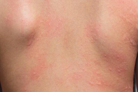 梅毒的症状是什么样子?这四个异常症状表现及时治疗