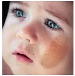 宝宝胎记是怎么形成的