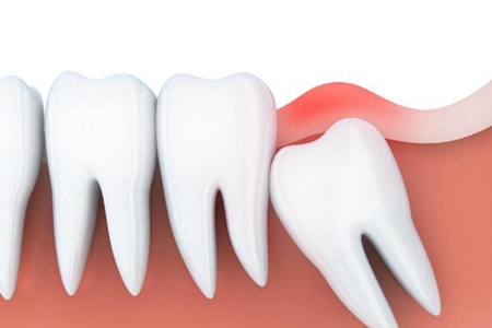 智齿一定要拔吗?这5种情况的智齿一定要拔